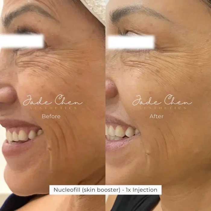 results showing the efficacy of Nucleofill treatments for facial wrinkles