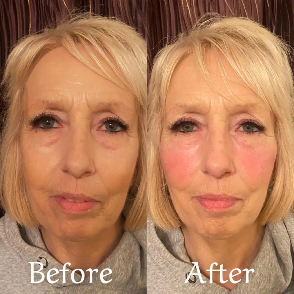 patient's good result