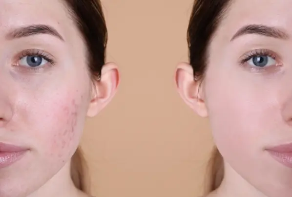 before and after getting the treatment for skin rejuvenation