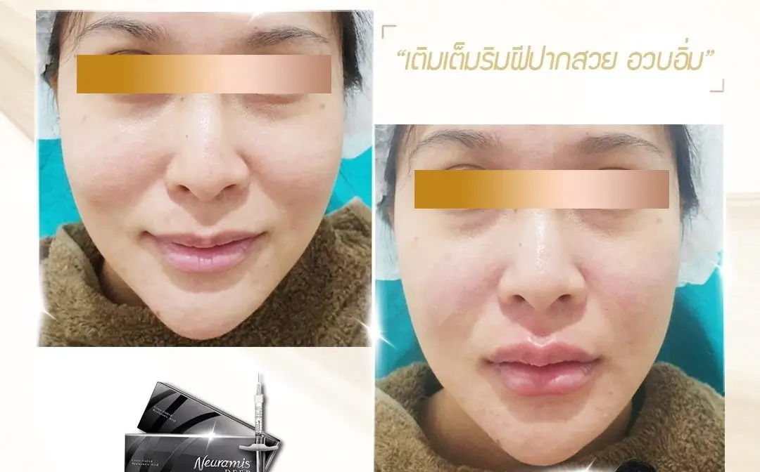 before and after operation