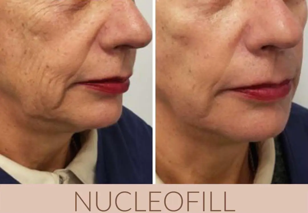 before and after for Nucleofill wrinkle treatment