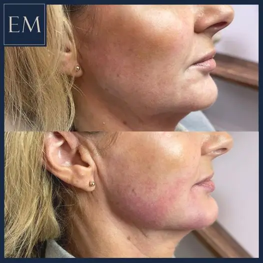 improved chin and volume