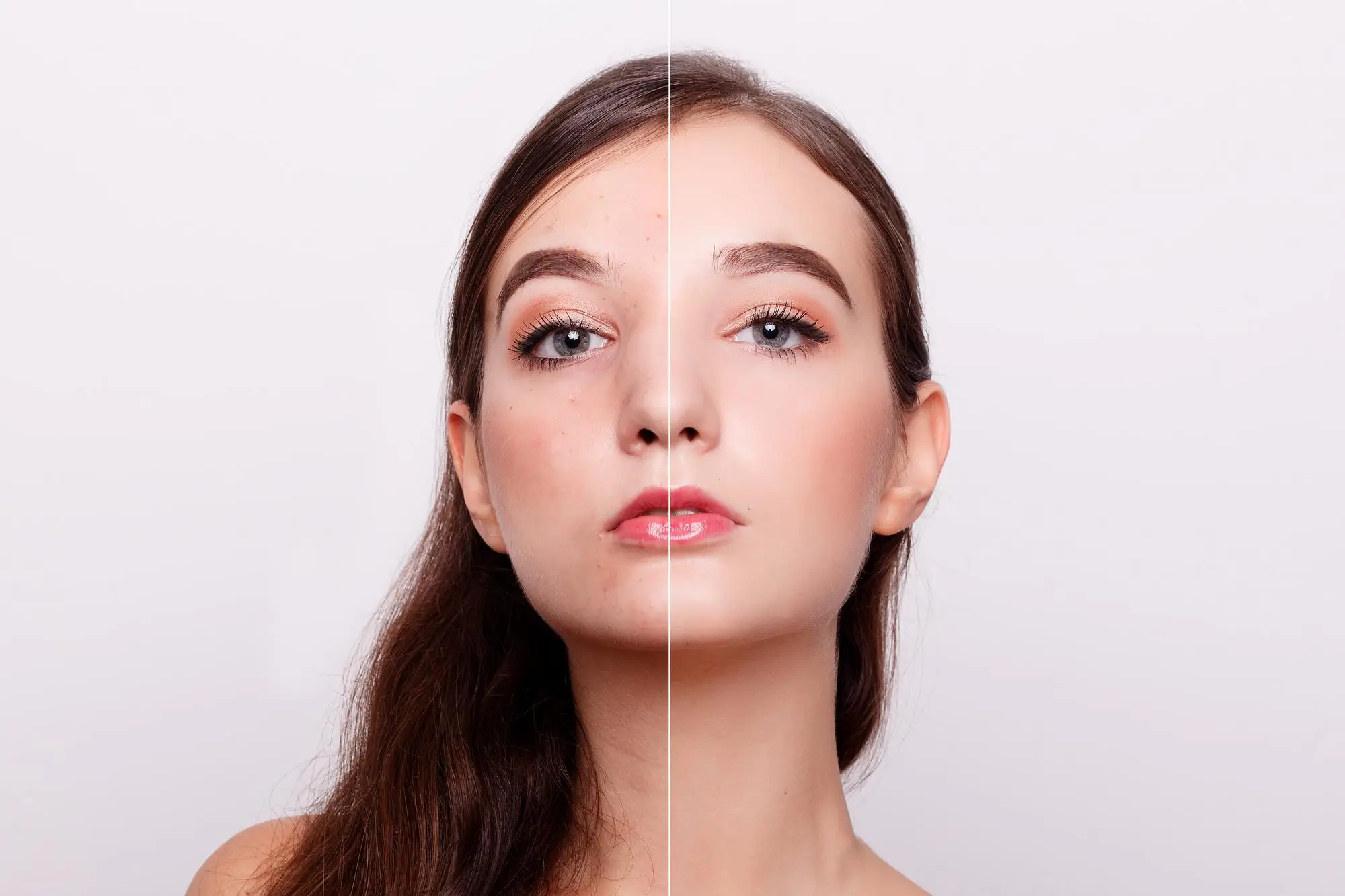 Woman's face split in half, showing before and after results of a facial cosmetic injectable treatment like Lemon Bottle skinbooster.