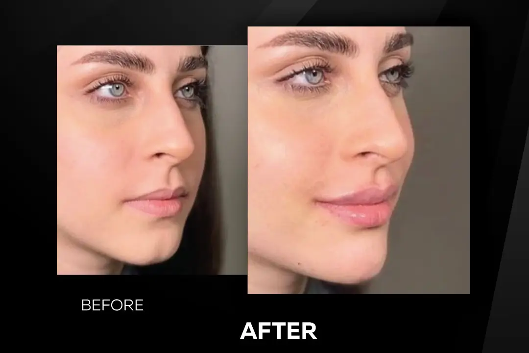 enhanced lips