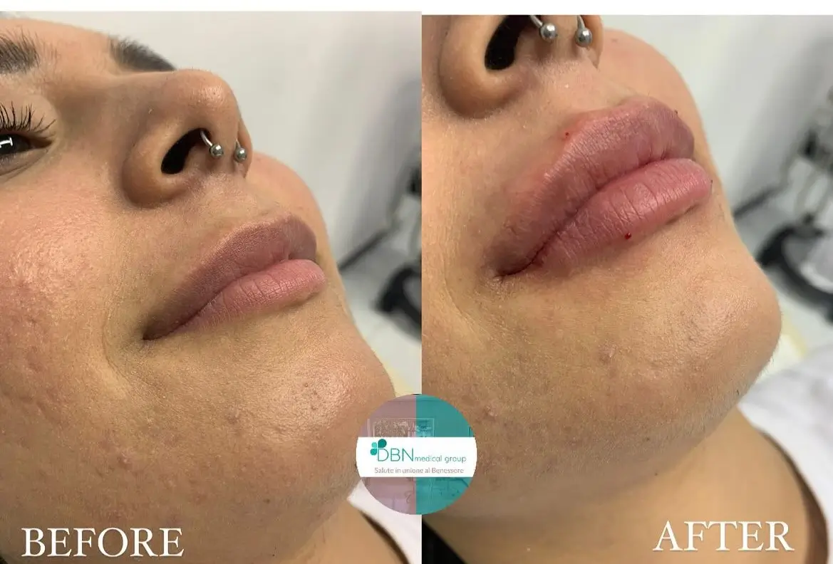 plumper lips