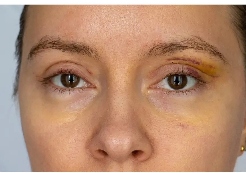 patient's eyes got visible wounds and bruises