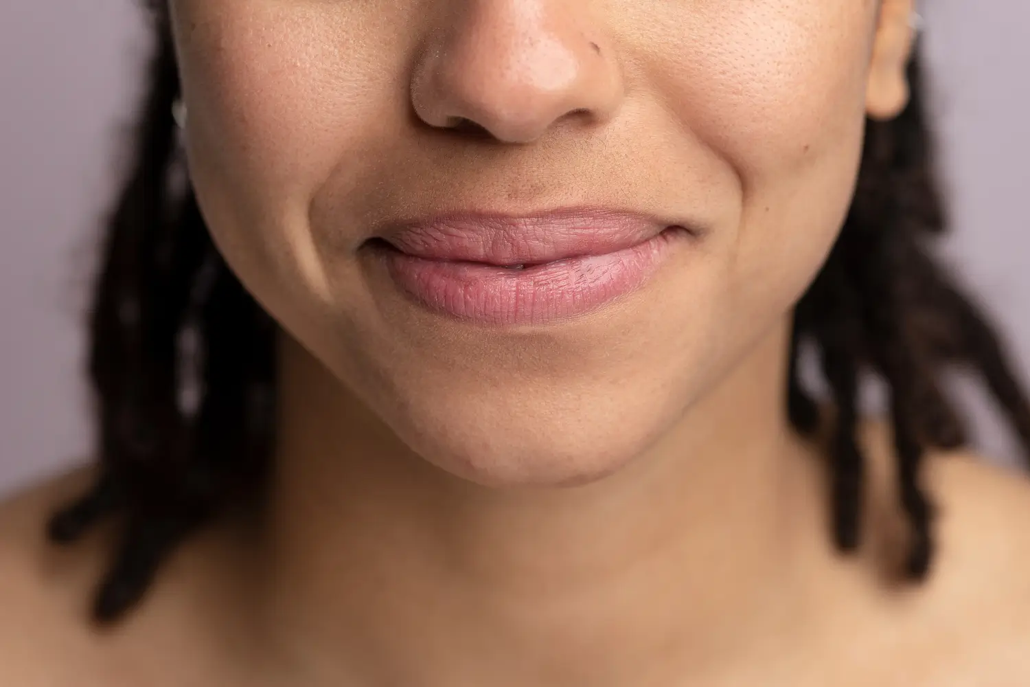 patient is smiling with the lines in the side of her mouth
