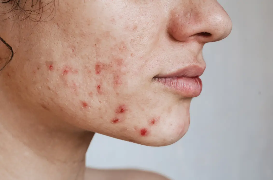 her skin is red and not flawless