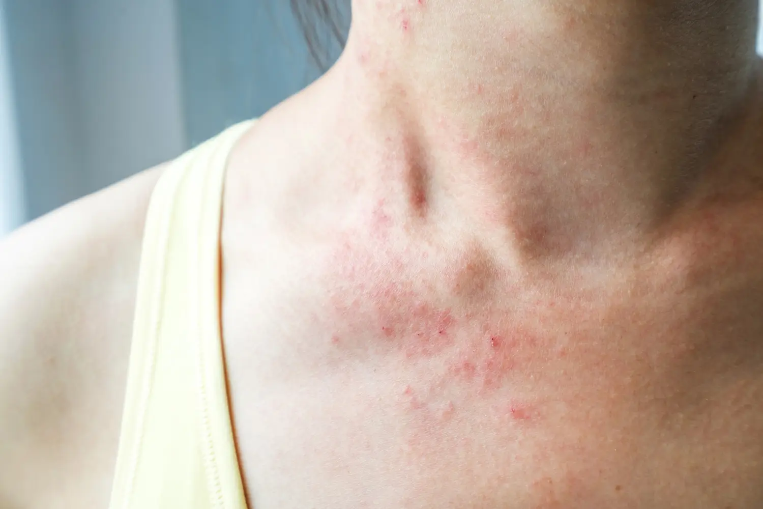 rashes in the neck looks red and itchy