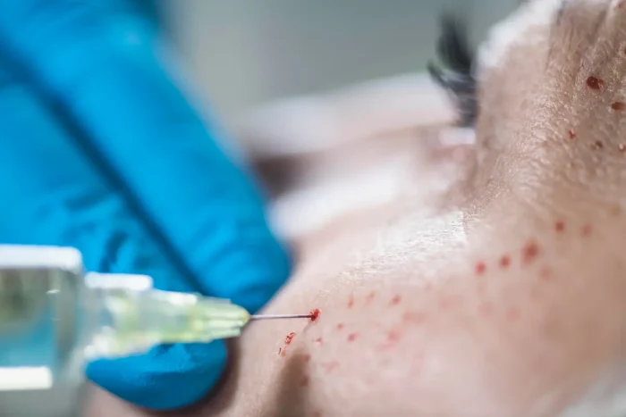needle marks