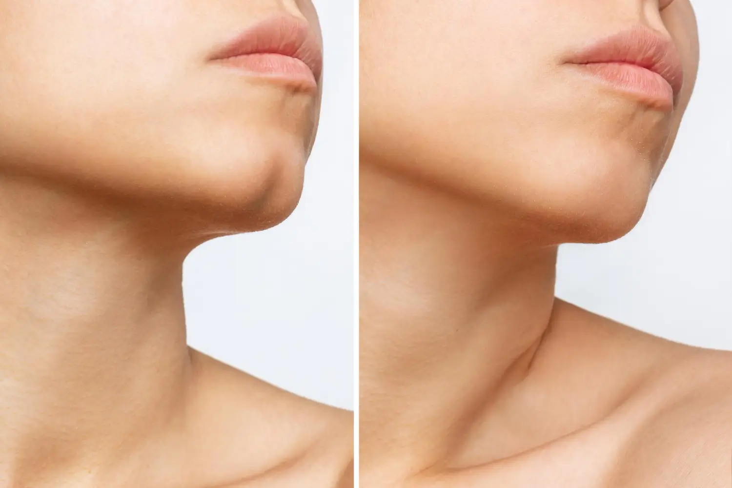 her jowls then and now after the operation