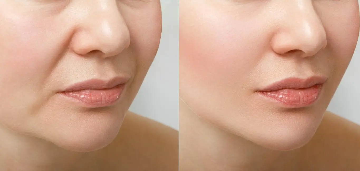 two photos showing patient's lines in the nose up to the chin