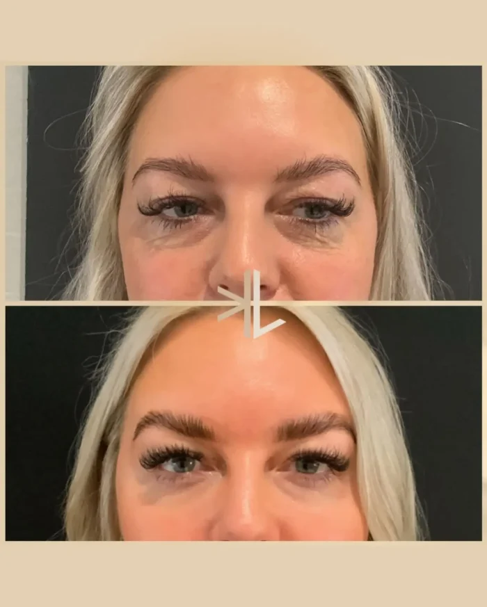 no more eye bags