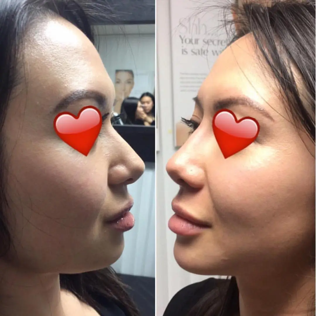 enhanced lips
