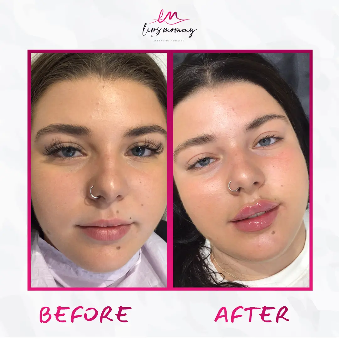 rejuvenated lips
