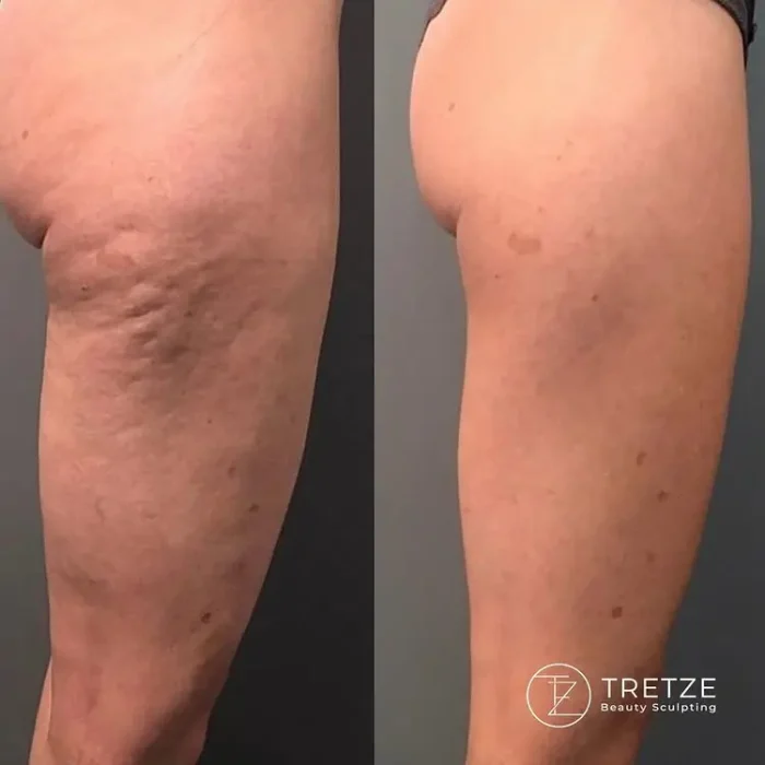 smooth and uneven skin