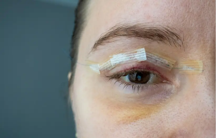 her eyelids were bruised but heals fast