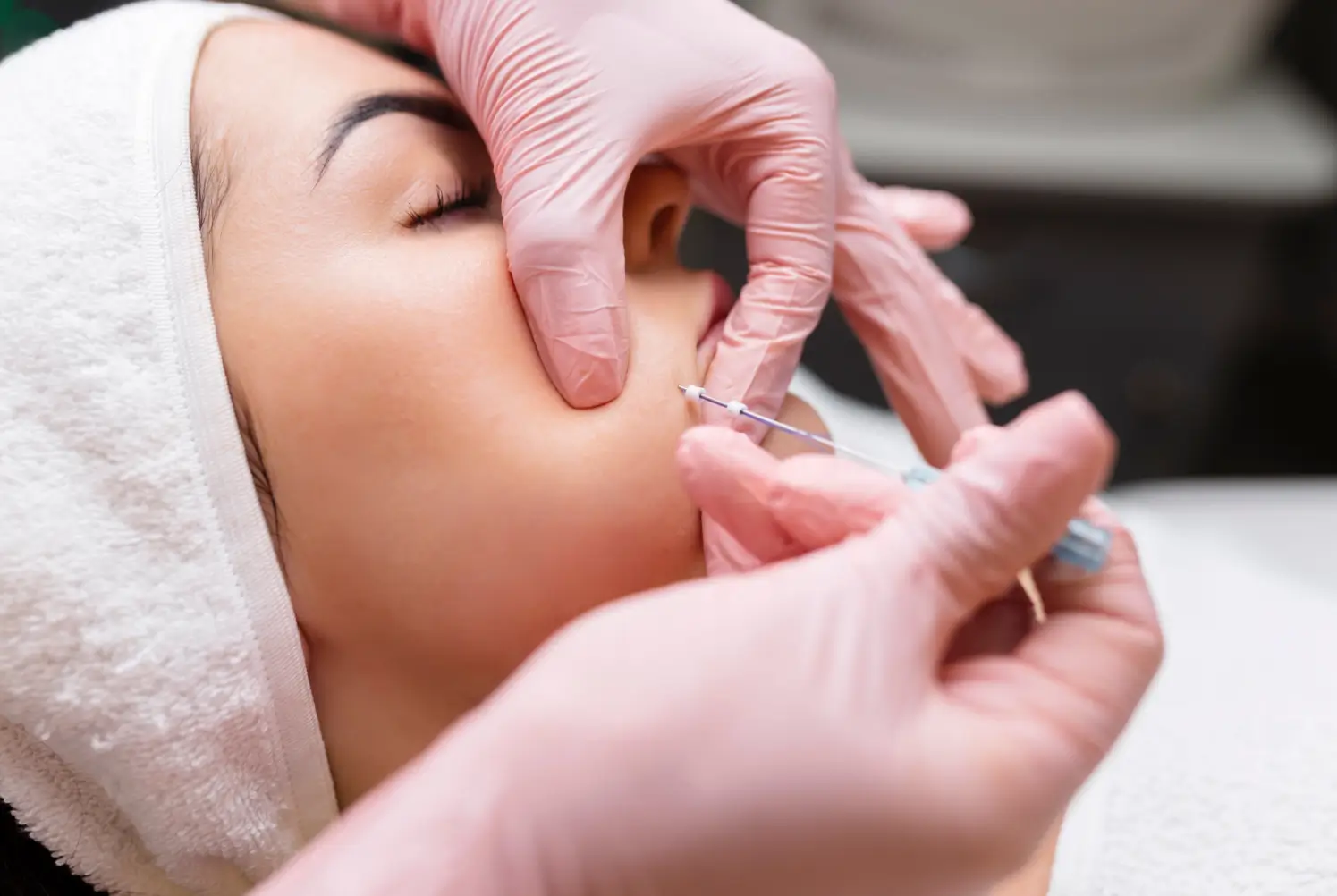 thread lift for her cheeks to make them more well-defined