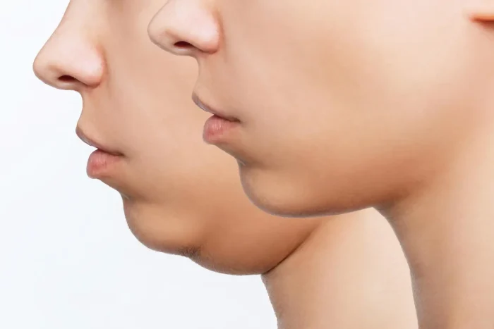 chin then and now