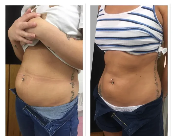 belly fat