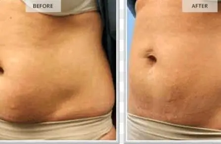 slimmer tummy