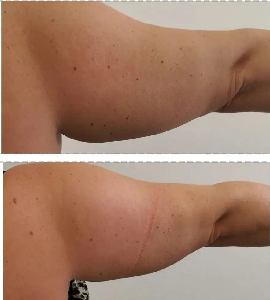 fatless arm