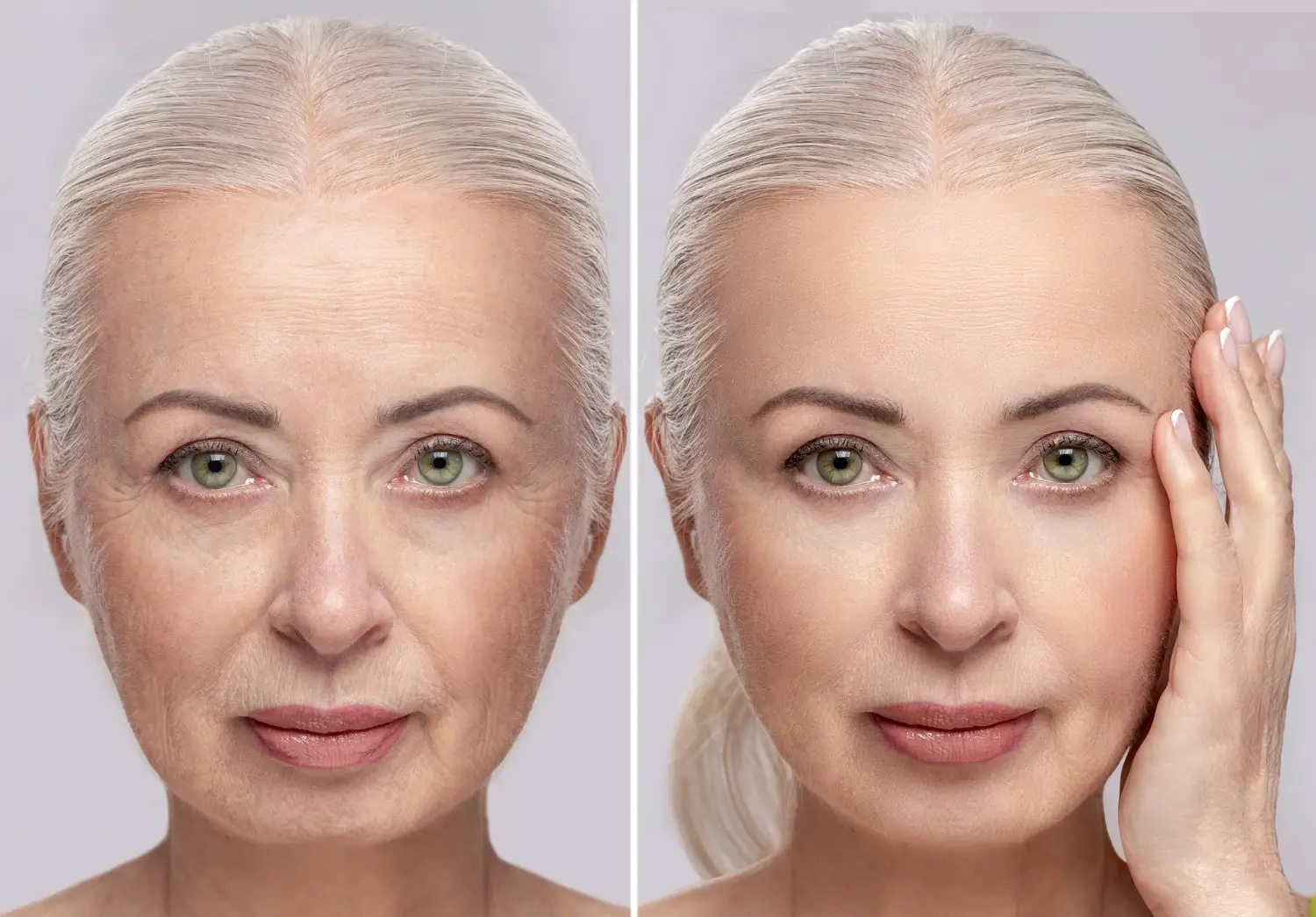 she looks younger after a few injections