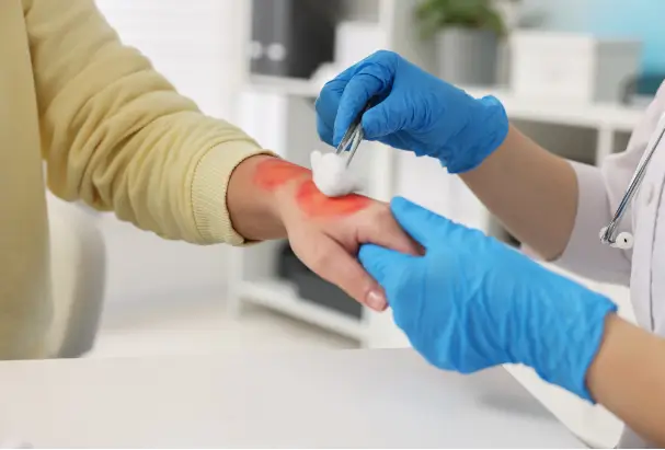 treating the burn on her arm