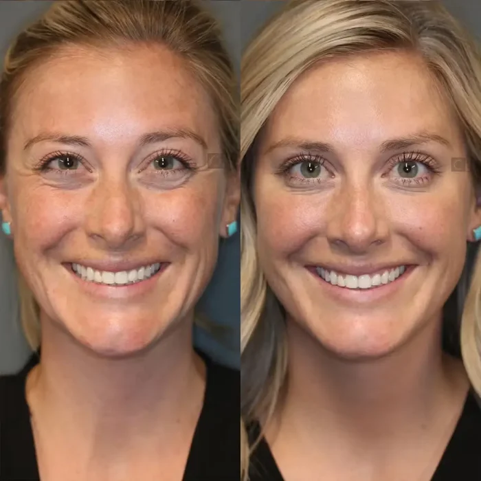 Her crow's feet are gone after getting neuromodulator treatments like Dysport.