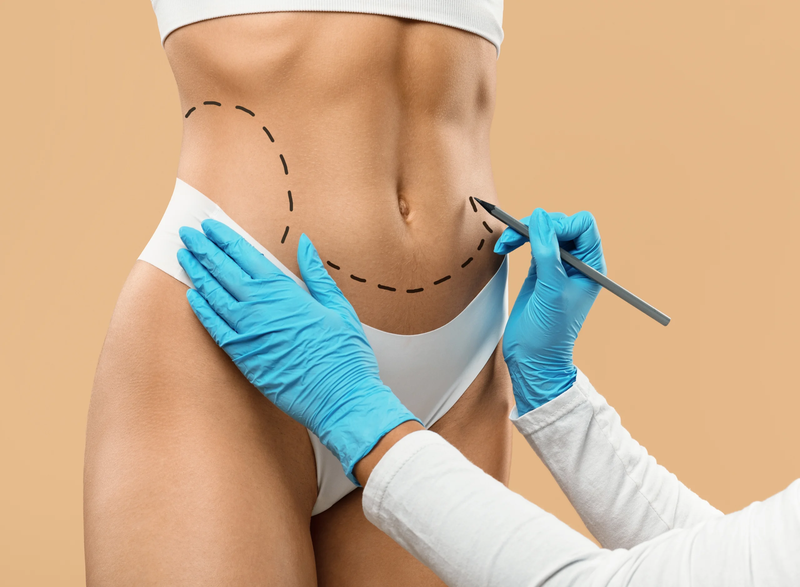 Fat Removal